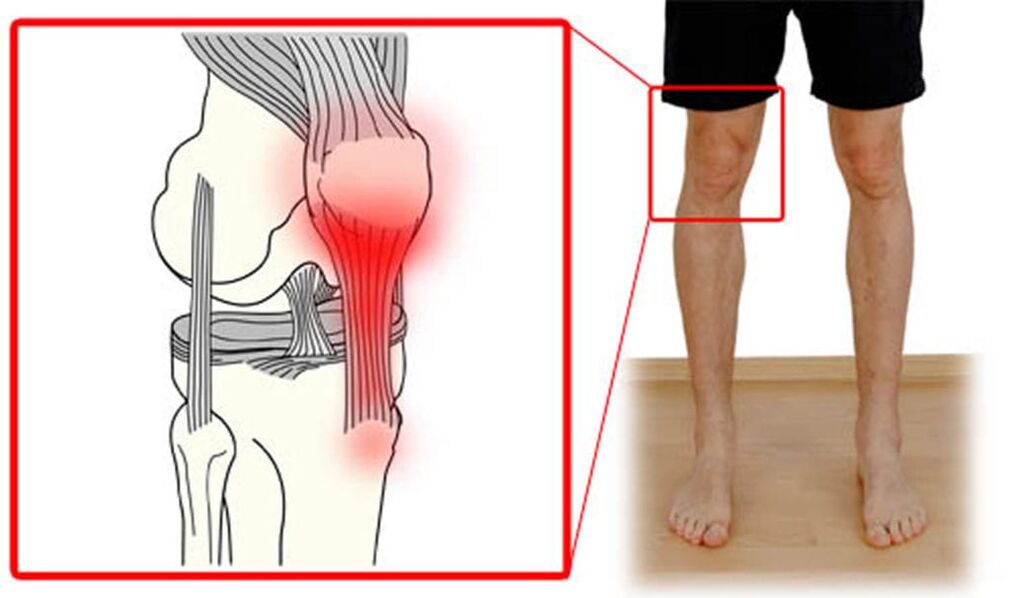 Tendinitis – Entzündung der Sehnen im Kniegelenk