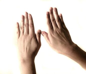 Die menschliche Hand ist komplex aufgebaut und anfällig für die Entstehung von Krankheiten