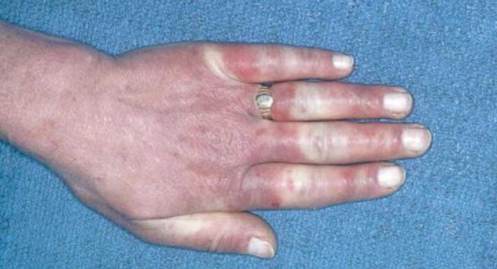 Klinisches Bild des Raynaud-Syndroms - Vasospasmus, Hyperämie, Ödeme