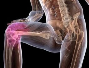 Schmerzen im Knie mit Arthrose